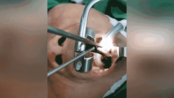 Video: Rùng mình cảnh gắp đỉa sống đang quằn quại trong họng nữ bệnh nhân
