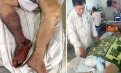 Uống thuốc tim mạch không đều, người đàn ông phải đoạn chi vì hoại tử nặng
