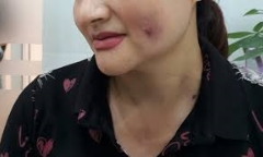 Má lúm đồng tiền thẩm mỹ: Đẹp đâu chưa thấy, chỉ thấy méo lệch mặt