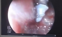 Bé gái 2 tuổi vô tình nuốt chiếc đinh xoắn ốc vào dạ dày