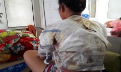 Điều tra nghi án chồng dội nước sôi vào người vợ