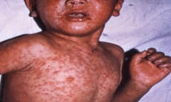 Bệnh có thể mắc ở bất cứ lứa tuổi nào: Phát hiện sớm và chăm sóc ra sao?