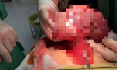 Tăng cân, chướng bụng, đi bệnh viện mới biết bị u gan khổng lồ