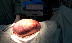 BV TƯ Huế: Bóc tách thành công khối u buồng trứng khổng lồ nặng hơn 5kg