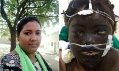 Vợ bị chồng tạt axit cháy xém mặt, mù mắt vì muốn tự đi làm kiếm tiền nuôi con