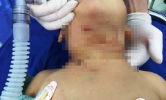 Tin tức đời sống mới nhất ngày 20/4/2019: Bé trai 3 tuổi bị chó đẻ hàng xóm cắn thủng khí quản