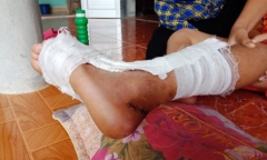 Làm rõ thông tin học sinh tiểu học đứt gân chân tại trường ở Thanh Hóa
