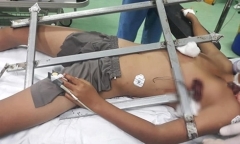 Nghệ An: Bé trai leo cây ngã bị rào sắt đâm xuyên ngực