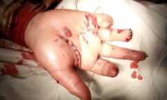Tin tức đời sống mới nhất ngày 6/2/2019: Một học sinh bị nát bàn tay do đốt pháo tự chế