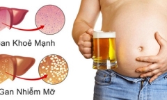 Phương pháp điều trị gan nhiễm mỡ tại nhà và những thực phẩm nên tránh