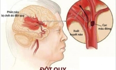 6 người thì có 1 người tiềm ẩn nguy cơ bị đột quỵ: Bạn tránh tử vong cách nào?