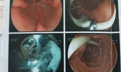 Tin tức đời sống mới nhất ngày 18/4/2019: Nghiện ăn rau sống, người phụ nữ bị cặp giun đũa dài 20 cm 