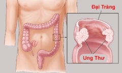 Bệnh ung thư đại tràng và những dấu hiệu, triệu chứng nhận biết
