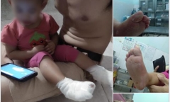 Bảo mẫu mở nhầm vòi nước nóng, bé gái 18 tháng tuổi bị bỏng 2 bàn chân