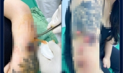 Bi hài hậu vận thẩm mỹ: Tiêm botox thon gọn bắp tay tại cơ sở Spa, cô gái nhận cái kết đắng