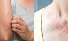 Ngứa da có phải là dấu hiệu cảnh báo bệnh ung thư hay không?