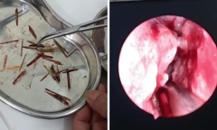 Hay chảy dịch và máu mũi, tá hỏa phát hiện 33 vật thể trong mũi cô gái