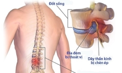 Giảm nguy cơ bị bệnh đau thắt lưng bằng cách nào?