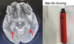 Hút thuốc lá điện tử trộn ma túy, nam sinh tổn thương não và tim