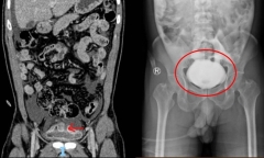 Nhịn tiểu lâu lúc uống bia, người đàn ông vỡ bàng quang sau khi té ngã