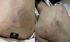 Diễn biến mới vụ bé gái mẫu giáo bị cô giáo đánh tím lưng tại Hà Nội