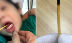 Vừa chạy vừa ăn thịt xiên, bé 3 tuổi gặp tai nan nguy hiểm phải cấp cứu