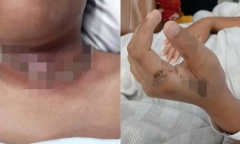Bé trai 9 tuổi bỏng nặng do thói quen sạc máy tính bảng gần giường