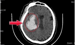 Tin tức đời sống 10/2: Người đàn ông đột ngột ngã gục sau khi tăng huyết áp không triệu chứng