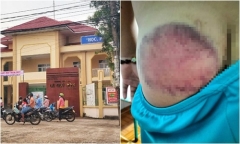 Quên mang sách, học sinh lớp 4 bị thầy giáo đánh bầm tím mông 