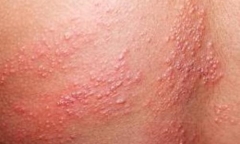 Biến chứng nguy hiểm khi mắc thuỷ đậu khiến nhiều bệnh nhân nhập viện dài ngày