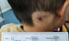 Phát hiện “cục thịt dư” đen thui sau gáy con, mẹ làm ngay 3 việc, bác sĩ biết chuyện khen nức nở