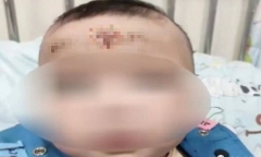 Trán bé gái 10 tháng tuổi đầy mẩn đỏ và vết loét, nguyên nhân khiến ai nấy giật mình