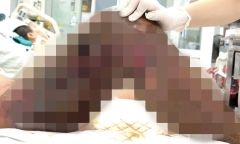 Người đàn ông hoại tử vùng loang lổ vì một vết xước nhỏ, suýt cướp đi mạng sống