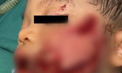 Bị chó nhà nuôi tấn công, bé 2 tuổi nhập viện với nhiều vết thương trên mặt