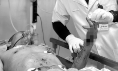 Tuyên Quang: Người đàn ông chấn thương nghiêm trọng do nổ bình ga mini khi đang nấu ăn