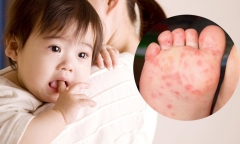 Bệnh tay chân miệng diễn biến phức tạp, cha mẹ chủ động phòng ngừa cho trẻ như thế nào?
