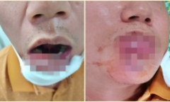 Mắc sai lầm phổ biến khi nặn mụn, người đàn ông nhập viện với đôi môi biến dạng