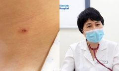 Người đàn ông bị suy thận cấp do bị ong vò vẽ đốt