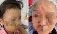 Lại gần khi xem chó nhà ăn, bé gái bị cắn tổn thương vùng mặt
