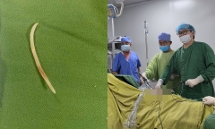 Người đàn ông bị áp xe gan do nuốt phải xương mà không biết