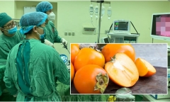 Ăn 5 quả hồng lúc đói, người phụ nữ phải nhập viện cấp cứu