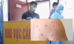 Đồng Nai: Ghi nhân thêm ca đậu mùa khỉ thứ hai