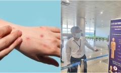 Việt Nam ghi nhận 56 trường hợp nhiễm đậu mùa khỉ, Bộ Y tế cảnh báo mầm bệnh đã xâm nhập trong cộng đồng