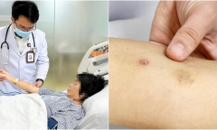 Cứu sống người phụ nữ nguy kịch do bị ong bắp cày đốt hơn 50 vết