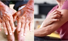 Những dấu hiệu trên da có thể cảnh báo bạn đang gặp vấn đề về thận