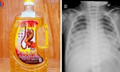 Cấp cứu bé 15 tháng tuổi nguy kịch do uống nhầm dầu thắp đèn