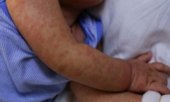 Sởi chưa hạ nhiệt, bác sĩ nhấn mạnh việc phụ huynh phải làm thời điểm này