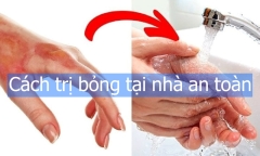 Cách trị bỏng tại nhà an toàn