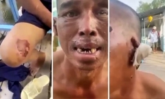 Vụ ngư phủ bị bạo hành trên tàu cá: Bị bẻ răng, bắt ăn 11 con cá sống