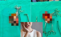 Mặt dài ra vì vết đen nhiều năm, người phụ nữ khiến bác sĩ 